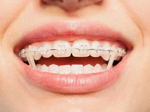 This is an example of braces.