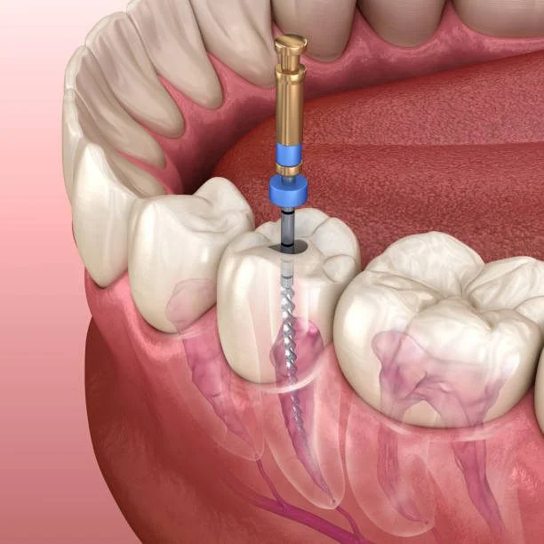This is an example of a root canal treatment.