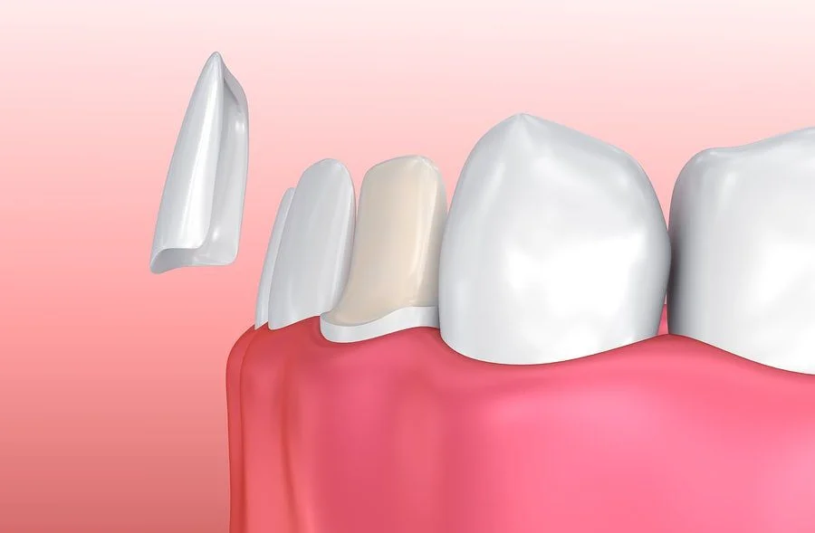 This is an example of dental veneers