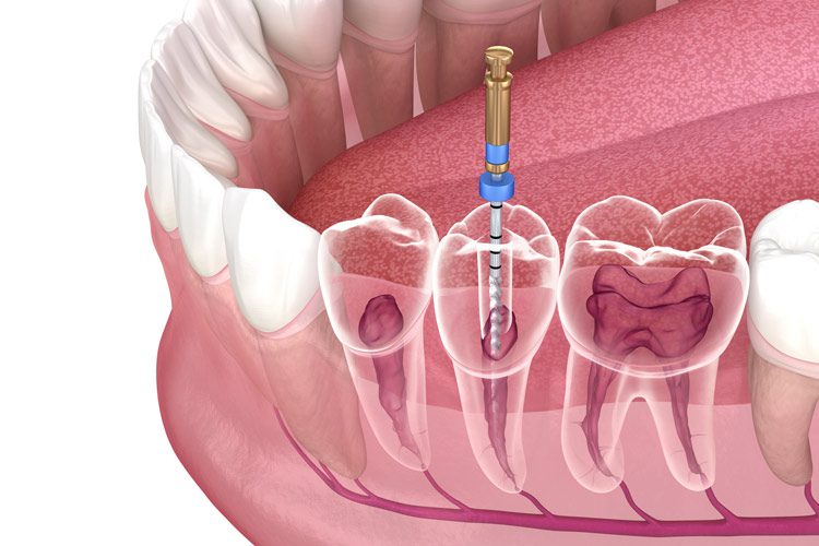 Root Canal Cancun