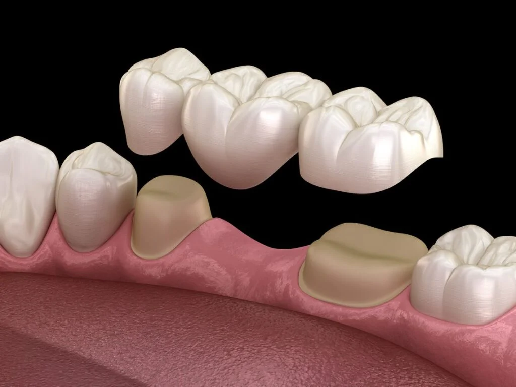 Example of the placement of a dental crown in a patient.